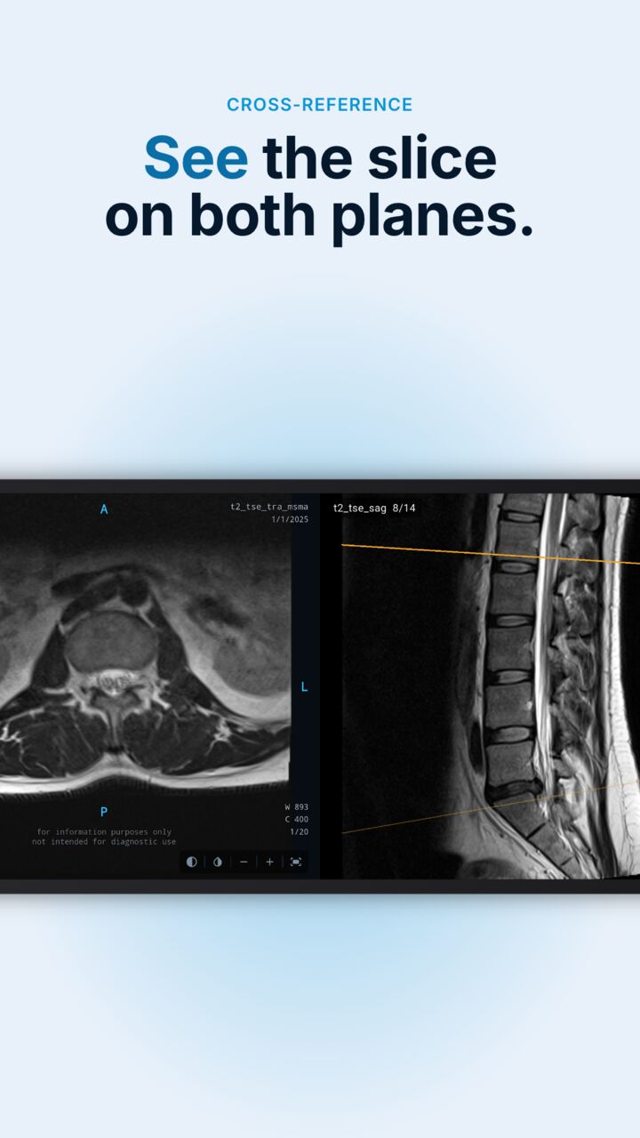 Radix DICOM showing an axial and a sagittal MRI of the spine with a reference line on each